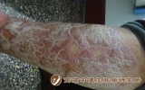 中重度银屑病是指哪种类型？医生说：这10家个关键点要明白