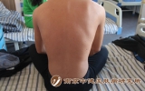 银屑病患者会并发代谢综合征?