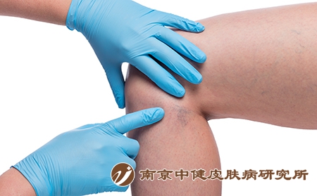 摄图网_303522806_医生亲手检查女腿和紧闭的容器上变血管（企业商用）