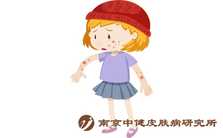 摄图网_401477102_长湿疹的女孩（企业商用）