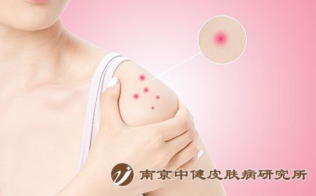 摄图网_500983105_肩部过敏红肿（企业商用）
