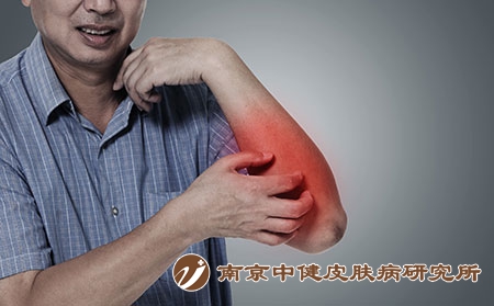 摄图网_401870392_皮肤红肿(企业商用) 摄图网_401870392_皮肤红肿(企业商用)
