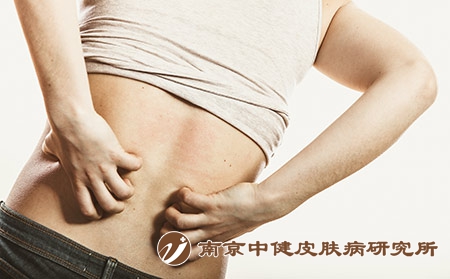 摄图网_304129678_人类抓痒的背皮肤过敏疹健康问题（企业商用）