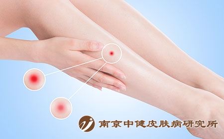 摄图网_500774826_皮肤发炎（企业商用）