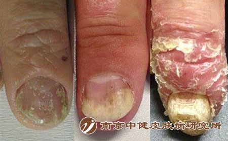 指甲牛皮癣2