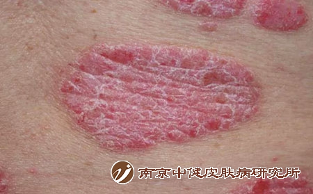 斑块状银屑病2 斑块状银屑病2